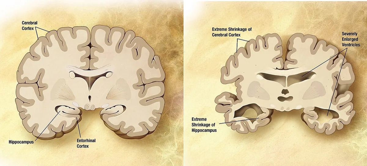 La maladie d'Alzheimer